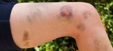 Bikers Rio Pardo | Dicas | Hematomas do MTB, como curar mais rapido!